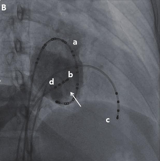 Pseudo R' was observed in precordial lead from V1 to V3 (arrows). A B Figure 2.