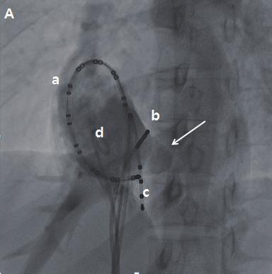 A pouch-like structure with contractility was observed in the lower septum of the RA (indicated by dot