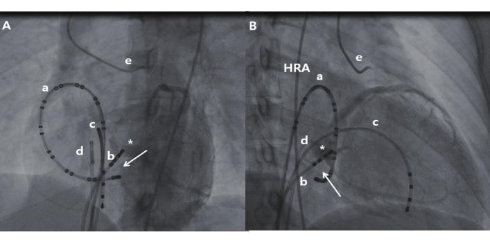 ECG & EP Cases A B Figure 3. Coronary sinus angiogram by retrograde approach for Case 1.