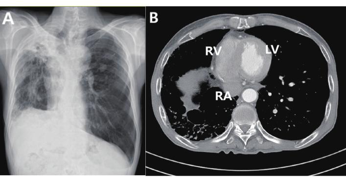 A B ECG & EP Cases Figure 5. (A) Chest radiography for Case 2. The right lung was destroyed by prior tuberculosis infection. (B) Chest computed tomography for the same patient.