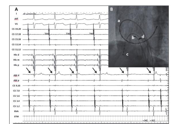 ECG & EP Cases A B C D Figure 6. Electrogram (A) and catheter position (B) for Case 2.