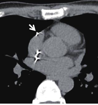 ECG & EP Cases Figure 1. Chest computed tomography shows penetration of the right atrium by the screw (arrow) of the right atrial lead. No pericardial effusion and pneumothorax are shown. Figure 2.