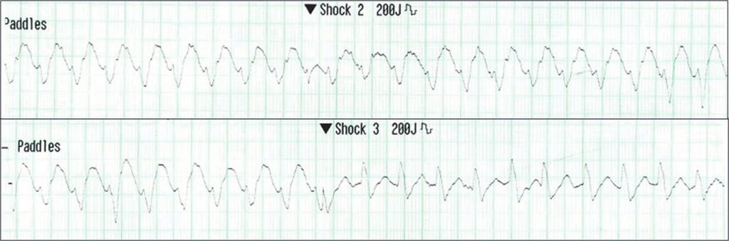 ECG & EP Cases Figure 1. Sustained wide QRS tachycardia even after an electrical shock. Occasionally, the QRS axis changed after an electrical shock. Figure 2.