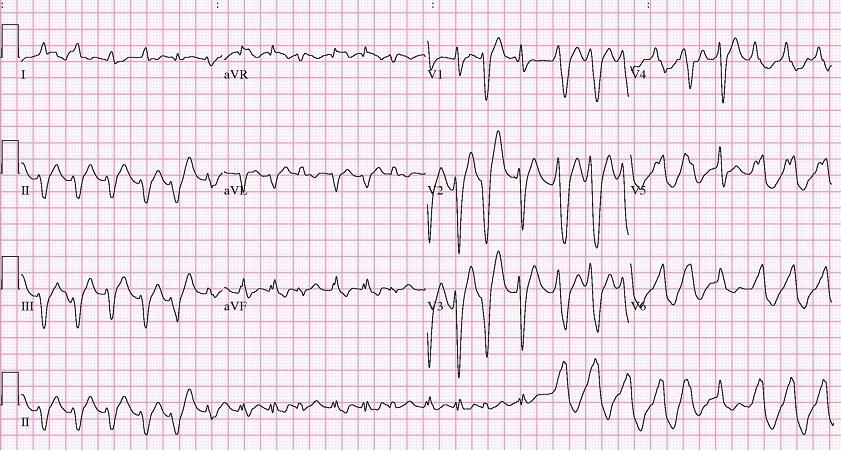 Upon arrival to the emergency room, her ECG showed a sustained wide QRS tachycardia of 150 bpm. Her blood pressure was 90/50 mmhg.