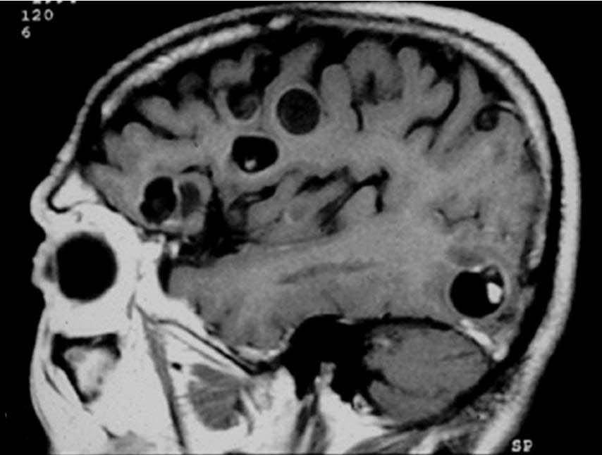 Racemose and ventricular type neurocysticercosis usually does not enhance and enlarged cisternal and ventricular spaces are common findings (C).