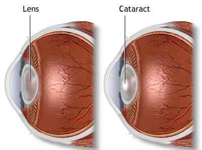 백내장 Cataract 망막주위의모세혈관의결함으로인하여영양소와산소의공급이어려운경우 수정체가혼탁해지는경우 ( 백내장 ).