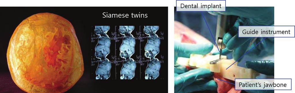 본 특집논문에서는 3D프 린팅 기술의 생체의료 분야에서의 일반적인 상용 소재 활용사례를 소개하고, 특히 재생의학 및 조 직공학에 특화된 기능성 생체재료를 활용한 3차원 지지체 제작 방법의 최신 연구동향에 대해 살펴보 고자 한다. 2.