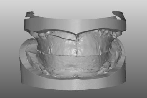 3D face scan 을이용한 D/M 제작의치증례 Fig. 6.