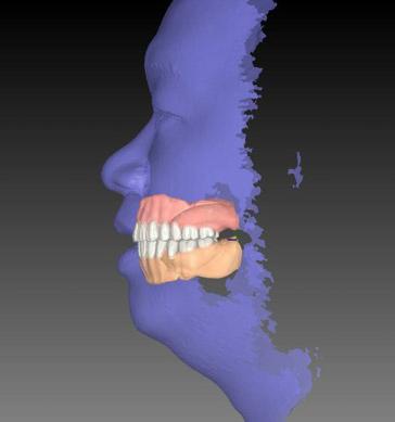 apparatus (SL) 방법으로의치상및인공치아를 3D 프린팅하여접착하였다.