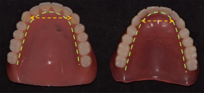 The left is conventional denture and the right is D/M fabricated denture.