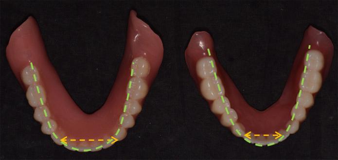 () onventional denture, () D/M fabricated denture. D/M 제작의치는전통적인방법으로제작한의치와비교하여많은장점을가지고있어더욱바람직한치료옵션이될수있다.
