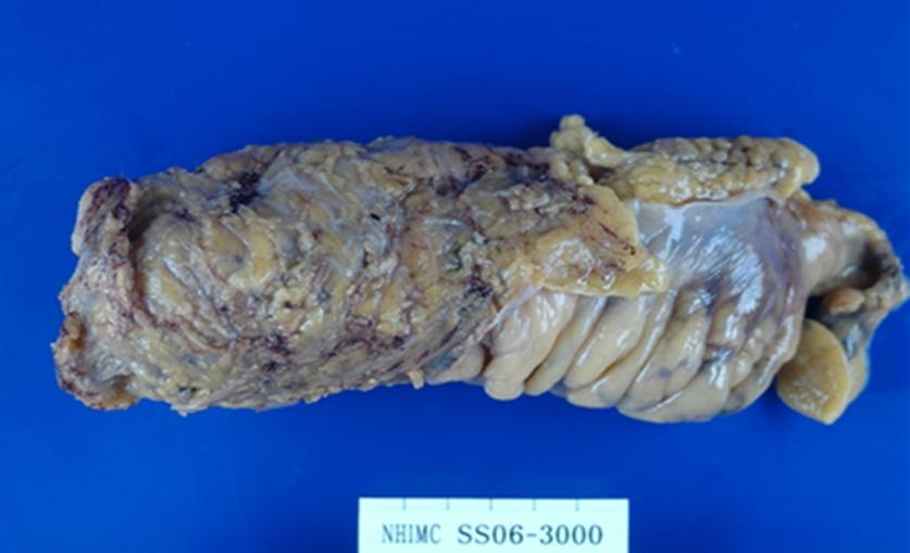 300 J Korean Surg Soc. Vol. 78, No. 5 Fig. 2. Preparation of whole mount section specimen. (A) The total mesorectal excision (TME) specimen was fixed in formalin without cutting.