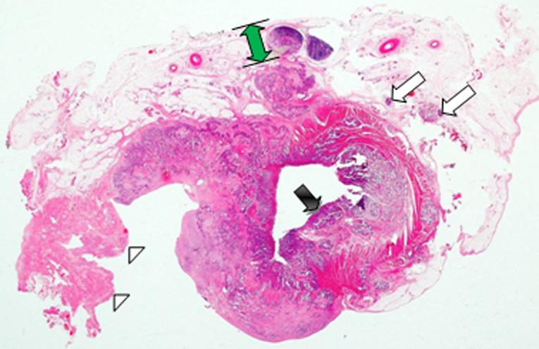 of patients (%) (n=63) 37 84 62.7 years Micrometastasis in mesorectum P-value Sex * Male 29 (46.0) 4 Female 34 (54.0) 2 Location of the primary tumor Mid rectum 33 (52.4) 4 Low rectum 30 (47.