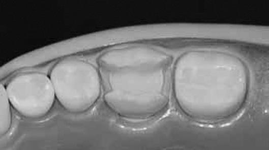 CEREC CAD/CAM System (Sirona Dental GmbH, Germany) (b) Intra Oral