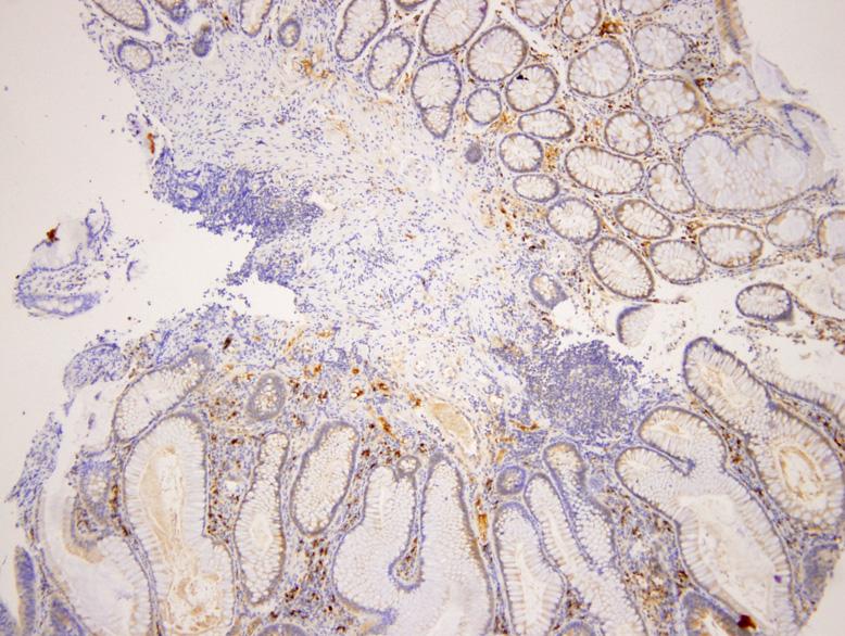 Choi MY, et al. The Effects of Family History of Colorectal Cancer on the Colorectal Adenoma 39 Fig. 1. Immunohistochemical expression of Bax in patient with family history of colorectal cancer.