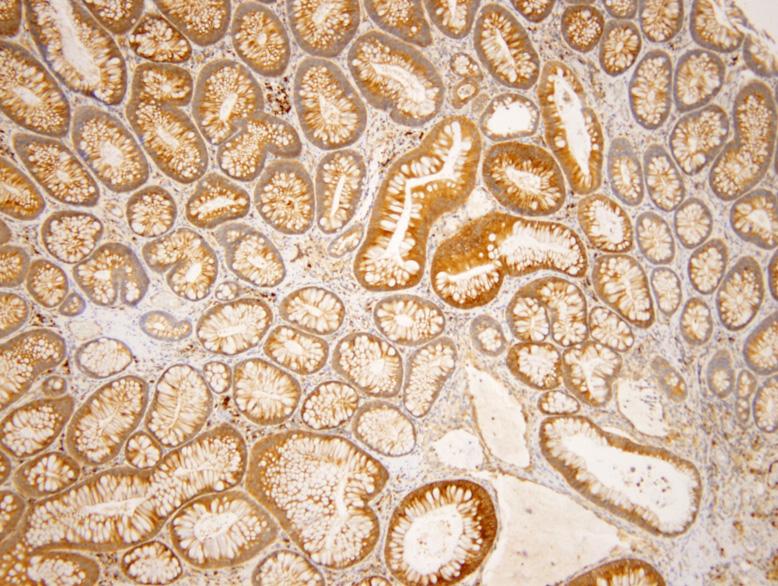 Immunohistochemical expression of Bax in patient without family history of colorectal cancer. The picture showed higher expression than those of patient group (H&E, 100).