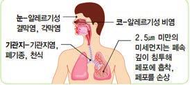 m3이상이 2 시간이상지속 황사경보 1 시간평균미세먼지농도 800 μg / m3이상이 2 시간이상지속 - 이론교육 미세먼지의유해성 입자가미세하여페포 ( 뇌 ) 까지직접침투 천식 폐질환유병률및조기사망률증가 세계보건기구 (WHO) 1군발암물질분류 ( 13)