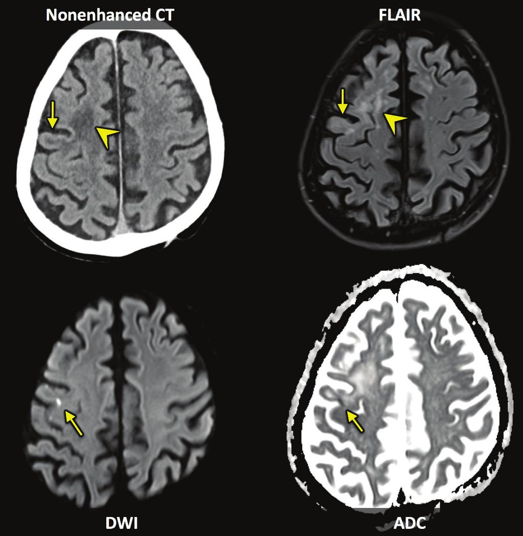 24 뇌졸중 MRI 의이해와정량분석 : 매트랩을이용한참조표준 / 뇌지도제작 1. 확산강조영상 급성뇌경색병변은, 세포손상및부종등으로인해정상뇌조직보다조직액물분자의확산이제한되므로, 확산강조영상에서주변뇌조직보다밝게보인다. 이는매우직관적이어서 CT에서발견하기어려운작은뇌경색병변 ( 그림 3-1) 이나초급성뇌경색병변 ( 그림 3-2) 진단시강점을갖는다.