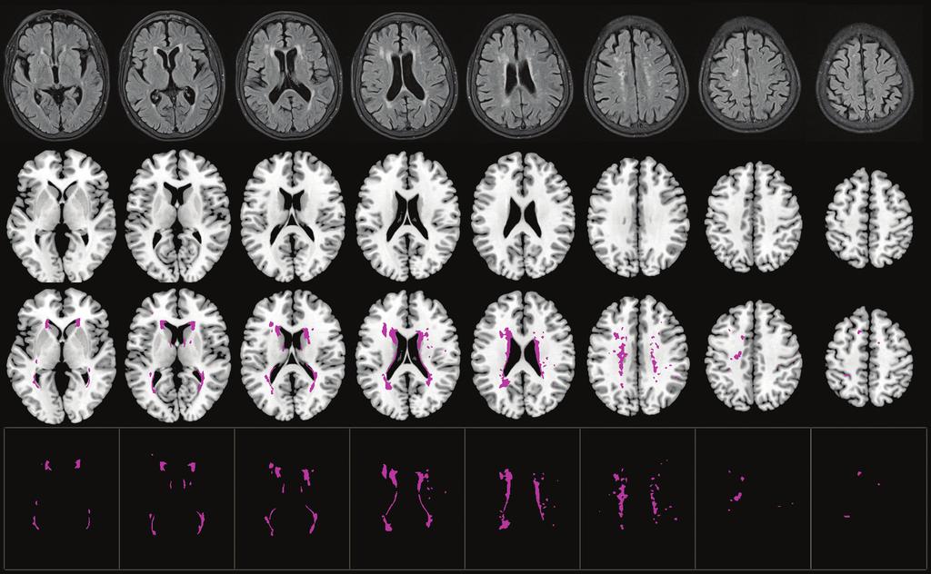 158 뇌졸중 MRI의 이해와 정량분석 : 매트랩을 이용한 참조표준 / 뇌지도 제작 그림 8 2 BMP 템플릿을 이용한 뇌허혈 병변 등록 예.