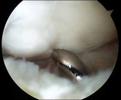 regenerated cartilage tissue (Grade