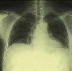 호흡운동에서흡기가일어날때, 늑골과횡격막의상태를설명하여라. 흡기전흡기시 공기가폐포로들어오는이유는무엇인가? 호기시 3. 운동을하면호흡운동은어떻게되는가? 또, 이를조절하는중추는어디인가? 4. 사고로호흡을멈춘사람에게응급처치로인공호흡을실시하는이유는무엇인가? 호기시와흡기시폐포와대기의압력차는얼마인가?
