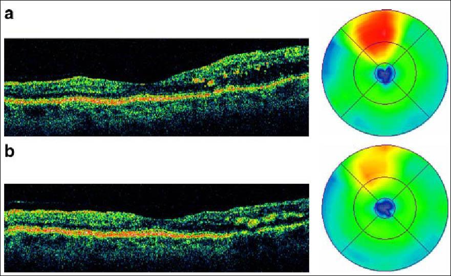 Selective retina therapy (SRT) for clinical significant diabetic macular edema.