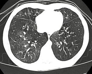 2. 폐쇄세관지염 (Bronchiolitis obliterans) 2.1 질병분류 ICD - 10 J44.8, J68.4 ICD - 9-CM 491.8 폐쇄성모세기관지염 (BO) 은염증으로인해폐의가장작은기도 ( 세기관지 ) 를막는질병이다 [157].[1]. 증상으로는마른기침, 숨가쁨, 천명음, 피로감등이있다 [157].