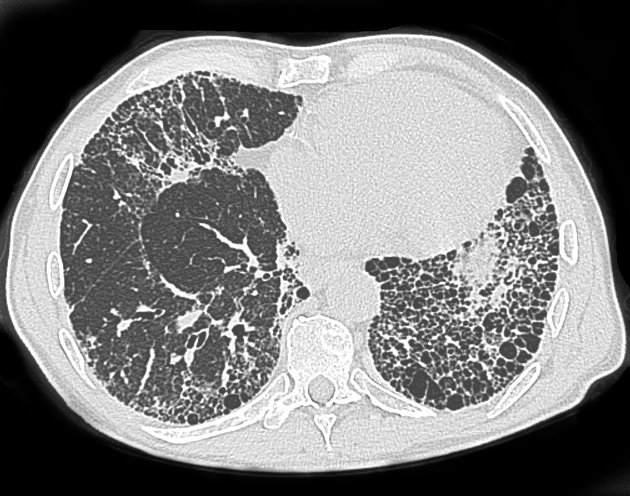 (2) 허니컴폐 그림 80. 허니컴폐 (Honeycomb lung) 여러낭종이있는다양한병리학적과정의거시적인모습을묘사하기위해사용된허니컴폐 (Honeycomb lung) 는이제폐사이의섬유화를설명하는데사용되는용어이다. 허니컴폐는일반적인간질성폐렴에서중요한 CT 소견중하나로간주된다 [313].