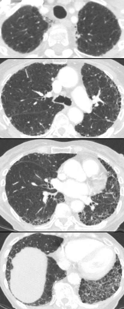 (3) 망상간질폐 (Reticular Opacity Lung) < 그림 81> 망상간질 망상간질패턴은폐섬유증의선형혼탁의패턴중하나이다 [314, 315].