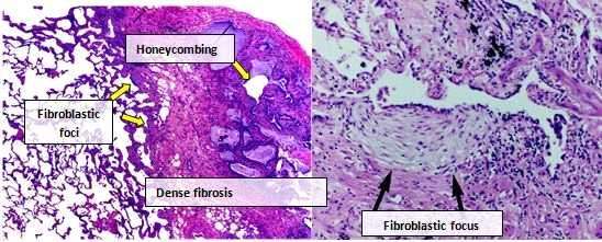 그림 82. 통상적인간질성폐렴의조직병리학적모습의현미경사진 그림 82 의고배율확대 ( 오른쪽 ) 는가벼운비특이적만성염증세포가침윤할수 있는섬유화영역에가까운섬유아세포증식을보여준다. 흉막내공간에서전형적인 벌집모양이인식될수있다. 4.5.3 기관지폐포세척 BAL (Bronchoalveolar lavage) 은 ILD의내약성진단절차이다 [165].