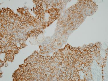 (B) The tumor cells were positive for alpha fetoprotein (AFP) (AFP immunohistochemical stain original magnification,