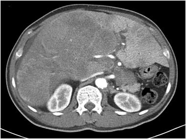 Abdominal and pelvic computed tomography scan.