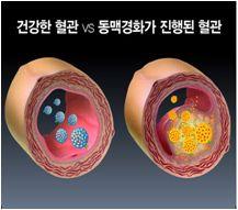 팔, 다리의동맥경화 손발의통증, 냉증및저림, 다리를저는등의보행장애, 다리에괴저발생 다. 치료및예방 금연한다. 흡연시발생하는일산화탄소는동맥의안쪽벽을손상시켜동맥경화증의원인으로작용한다. 고혈압을관리한다. 혈압이높으면동맥혈관이손상된다. 당뇨병을조절한다. 당뇨병은지질대사이상으로혈중지방수치를상승시키고혈관을손상시킨다.