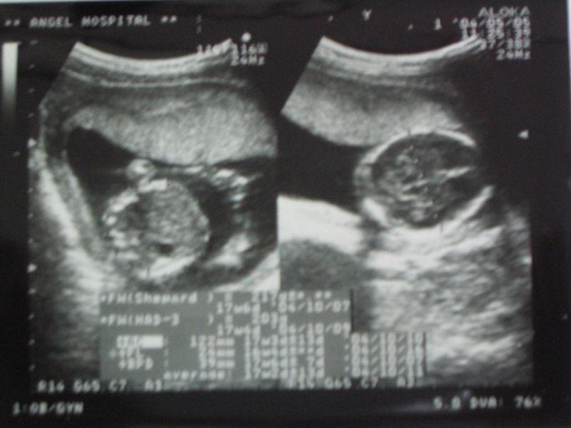 체질진단 Fig.4a Echo view of 17w+3. Fig.4b Echo view of 17w+3(Abdomen & Head).