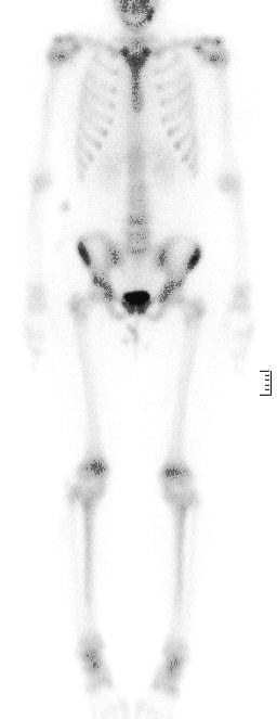 그림 12의영상에서왼쪽 (MDP를이용한 Bone scan), 오른쪽 ( 18 F만을이용한 Bone PET 영상 ) 이다. 설명에관하여옳은것은?