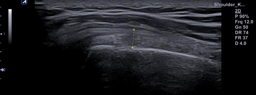 dashed line) and blue portion of supraspinatus muscle (open arrow). Fig. 3.