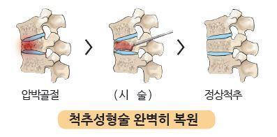 골다공증성척추압박골절의대표적인비수술적치료법 - 척추성형술 척추성형술의장점?