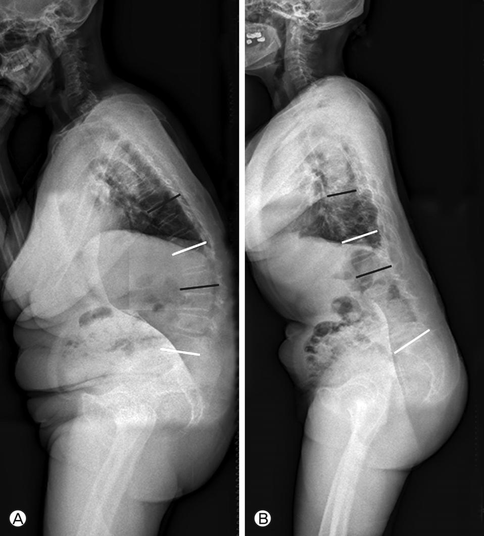 Sagittal Imbalance Fig. 3. A, The patient with low value of PI shows flat or negative angle of SS and thoracolumbar junction kyphosis.