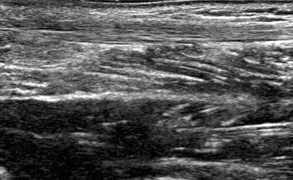 331 Figure 10. Anisotropy. Long axis scan of the Achilles tendon. (A) Normal hyperechoic tendon.