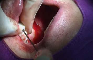 surgery 전용 mount 체결 Surgical template 를통과하여 implant 식립