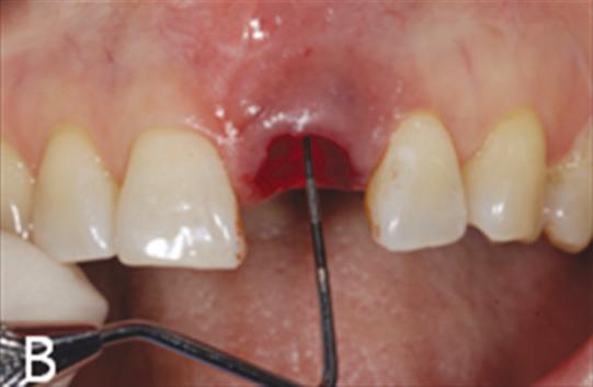 mg, 근화제약 ) 를복용하도록지시하였다. 발치와처치후피판형성없이 bone-level SLA (Straumann Dental Fig. 1.