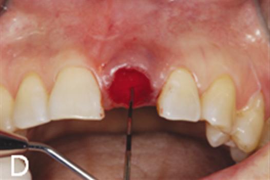 A: Maxillary left central incisor from labial view, B: Maxillary left central