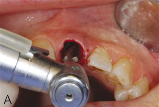 Implants, Basel, Switzerland) 임플란트직경 4.8 mm 길이 14 mm 를제조사에서제시한술식에맞춰식립하였다.