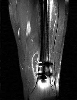 뒤에시행한초음파에서도재발없이호전소견을확인할수있 었다 (Fig. 8). 고찰 Figure 8. Follow-up ultrasonography of the left distal thigh showed resolution of the hematoma. 초음파검사상좌측대퇴골의원위부교합나사부위에 4.3 8.0 1.