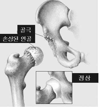 ㄴ. 증상 대개성인이될때까지는증상이없는경우가