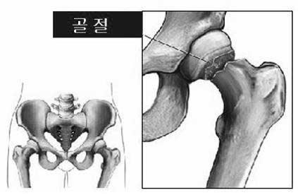 흔히보는고관절질환 2. 중년이후생길수있는고관절질환 3.