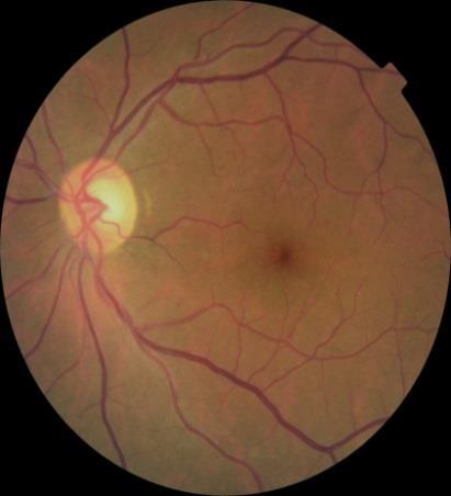8495 No signs of diabetic retinopathy Severe signs of diabetic retinopathy 주 ) Kaggle Competition the world s largest community of data