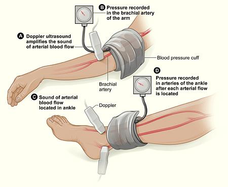 로팔동맥 - 발목동맥간압력의변화를측정하는방법이많이사용되고있다 ABI 정의 ABI는발목수축기혈압을팔수축기혈압으로단순히나눈값으로정의한다. 오른쪽과왼쪽을따로계산하기도하며, 발동맥혈압은낮은쪽을팔동맥의혈압은높은쪽을선택하여계산하기도한다.