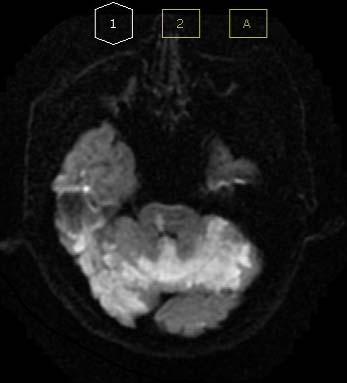 중추성현훈및소뇌성보행실조환자의한방치료치험 2 례 6. 과거력 1) HIV(+) 2009년. medication 중 2) Cervical HIVD(Herniation of Intervertebral Disc) 시술. 2016년 06월. 7. 가족력 : 없음. 8. 사회력 : Alchole(-), Smoking(+) 하루 1.5~2갑 9.