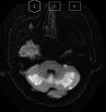 주요검사및평가소견 1) 혈액 / 소변검사 : 특이소견없음 (Table 1). Fig. 1. Brain MRI AXL DW1 scan (2017.05.08). Table 1. Result of Blood Test Lab Result 참고치 CBC MCV* (fl) 99.8 81.